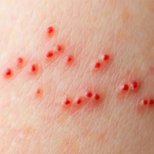 ugryzienie pluskiew przed fumigacja