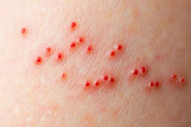 ugryzienie pluskiew przed fumigacja